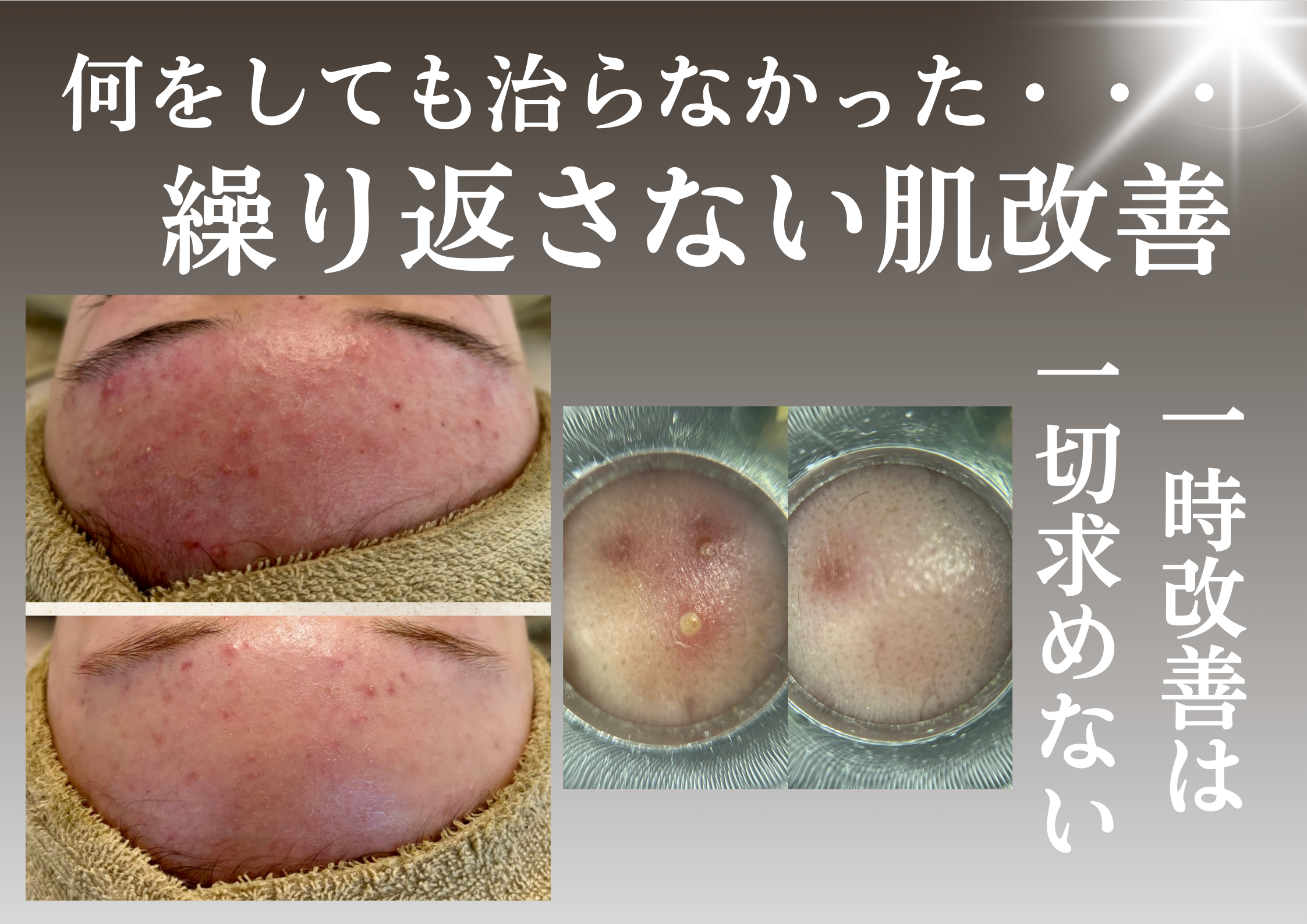 【肌質改善】ハーブピーリング